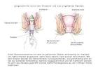 Große Probleme beim Stuhlgangmit Hämorrhoiden - Onmeda-Foren