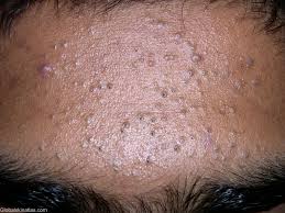comedonal acne