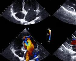 Image of Echocardiography
