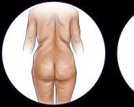 Image of liposuction procedure