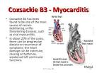 Coxsackie virus myokarditis