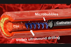 Ultrasound Twisting to Dissolve Blood Clots