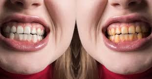 Beyond Home Kits: How Professional Teeth Whitening Delivers ...