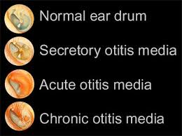 Image result for otitis media