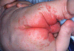 Image result for newborn diaper rash