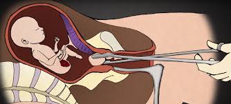 Resultado de imagen para el aborto