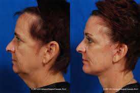 See Face Lift Before and Afters facelift chattanooga - facelift-profilebeforeafter-9