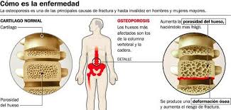 Resultado de imagen para IMAGENES DE VERDURAS PARA LA OSTEOPOROSIS