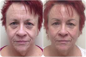 ... skin resurfacing, Anti Wrinkle injections )- Dr Ehsan Jadoon. Makeovers &middot; Surgical &middot; Medical &middot; Video - 23