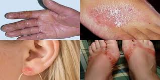 Resultado de imagem para sinais e sintomas dermatite