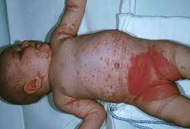 Image result for newborn diaper rash