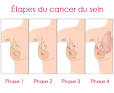 Symptome du cancer du seing