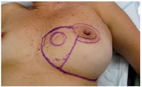 Resultado de imagem para radioterapia marcações de áreas