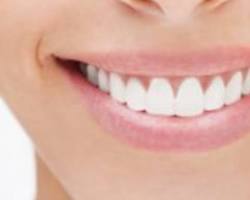 Image of Healthy smile