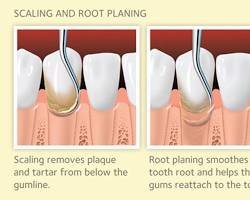 Image of Dental Scaling and Root Planing