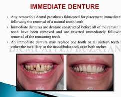 Immediate dentures