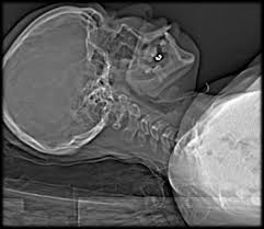 CT Myelography: How to Do It
