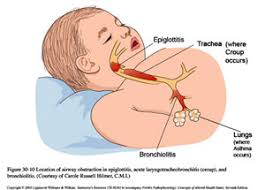 Croup