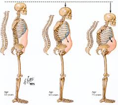 Vitamin D dan osteoporosis