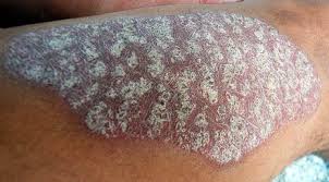 Image result for PSORIASIS