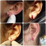 How to treat infected stretched ears? 