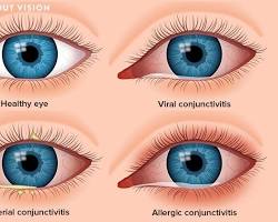 Image of Conjunctivitis symptoms