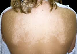 Image result for Tinea versicolor