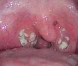 Image result for tonsilith