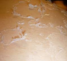 Image result for skin shedding on hands