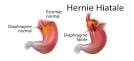 Hernie hiatale : quels sont les symtmes? - t