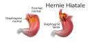 L hernie hiatale : rem des? R solu - Sant -M decine