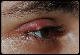 Résultat de recherche d'images pour "eye infection"