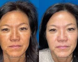 Image of Before and After Photos: Patient 1