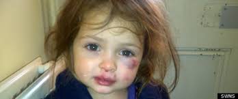 Katie Ann Guttridge, Three, Beaten Black And Blue By Two-Year-Old At Nursery. Katie Ann Guttridge sustained a bruised eye socket, scratches and bite marks ... - r-KATIE-ANN-GUTTRIDGE-large570