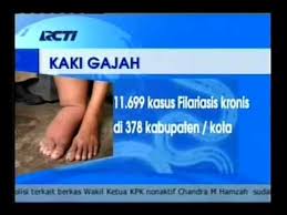 Image result for Filariasis / Penyakit Kaki Gajah