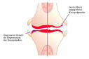 Deutsches Ärzteblatt: Arthrose: Chondroitin und Glucosamin