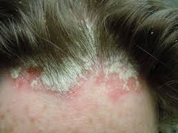 Image result for PSORIASIS