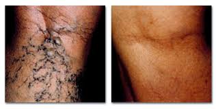 Varicose veins, surgery, multiples 