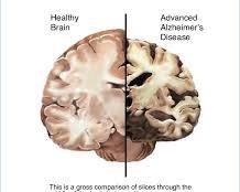 Image of brain with Alzheimer's disease