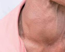 Maladies thyroïdiennes