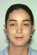 Resultado de imagen para Facie febril: