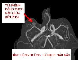 Kết quả hình ảnh cho mri sọ não