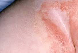 Image result for newborn diaper rash