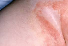 Image result for newborn diaper rash