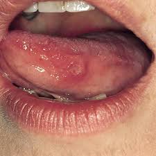 Znalezione obrazy dla zapytania candida na języku