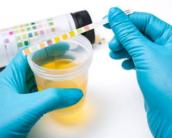 Image of Urinalysis test