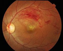 Image of Retinal vein occlusion