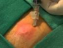 Abscess Incision and Drainage - procedure, blood, tube, pain, time