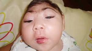 Image result for images of zika babies