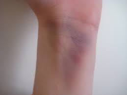 Resultado de imagen para hematomas